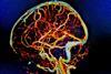 Brain MRI, cerebral vessels