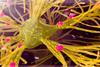 A digital artwork of a nerve cell with amyloid plaques