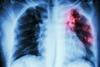 Pulmonary Tuberculosis chest X-ray