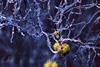 Amyloid plaques amongst neurons