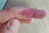 An image showing the needlestick injury