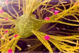 A digital artwork of a nerve cell with amyloid plaques