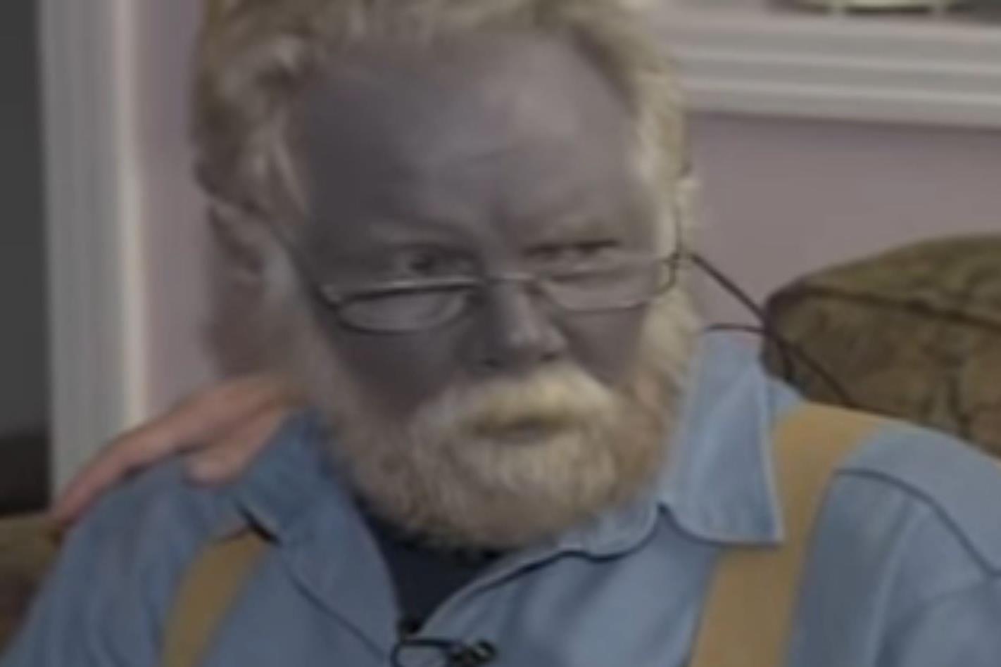 Bizarre 'Papa Smurf' resurfaces on the internet; know how overuse of  colloidal silver caused a man to turn blue