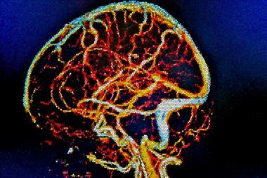Brain MRI, cerebral vessels