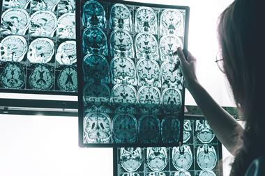 Photograph of x-ray brain scans on a wall-mounted lightbox