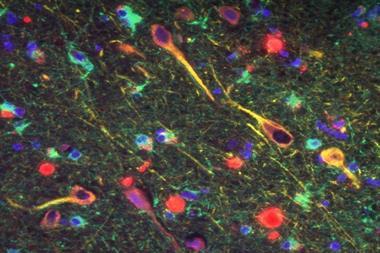 An image of P. gingivalis' gingipains in the neurons of Alzheimer's brain