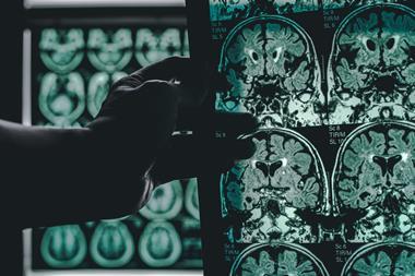shutterstock 664361164 MRI brain scan of an Alzheimers patient