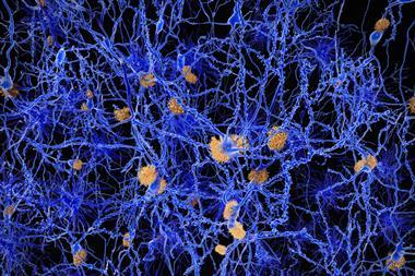 Understanding Alzheimer's - Amyloid plaques