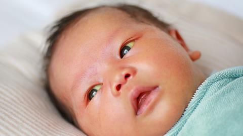 Infant with Neonatal hyperbilirubinemia. Jaundice.