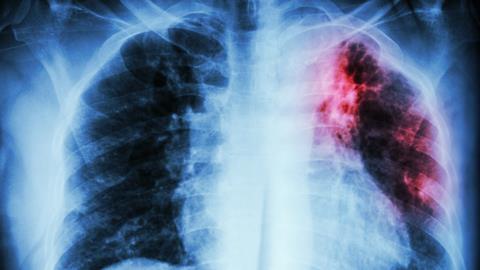 Pulmonary Tuberculosis chest X-ray