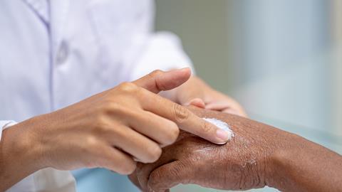 doctor applying steroid moisturizer cream on old man's hand