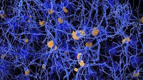 Understanding Alzheimer's - Amyloid plaques - HERO