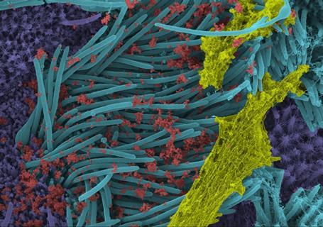 Coloured scanning electron microscope image of SARS-CoV-2 infected human bronchial epithelial cells