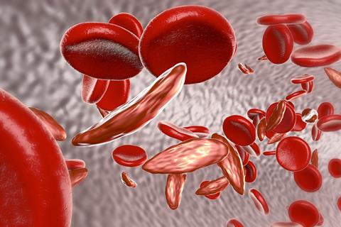 Sickle cell disease