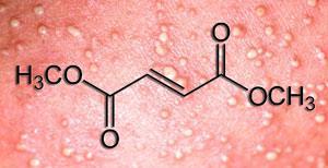 dimethly-fumarate-rash-300