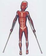 muscular-dystrophy-150