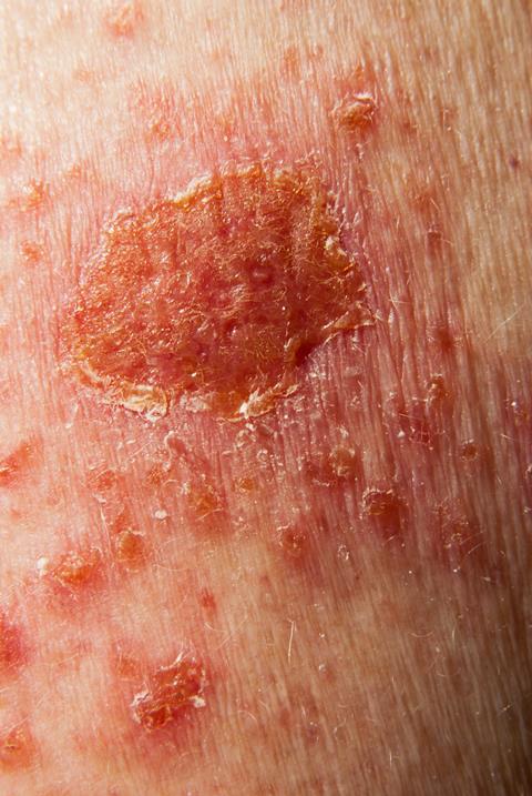 Effects of  5 percent fluorouracil topical treatment for skin cancer