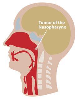 nasopharyngeal carcinoma symptoms