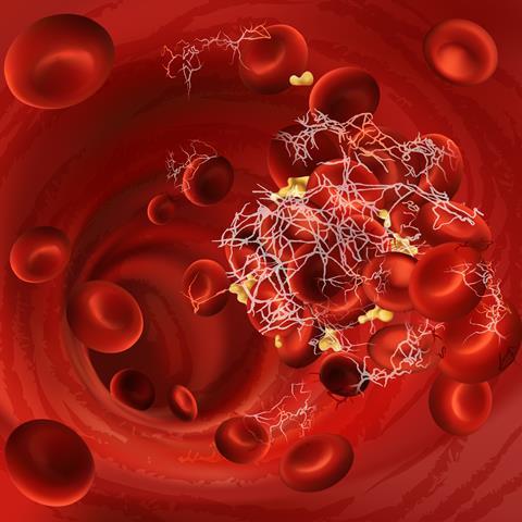 Vector illustration of a blood clot, thrombus or embolus with coagulated red blood cells, platelets in the blood vessels of the body 