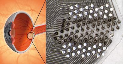 Diagram showing cut-away profile of an eyeball zooing into a diamond implant