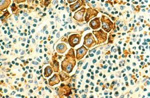 Breast-cancer-cells-300