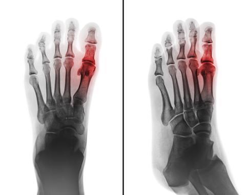 Film x-ray of human foot and arthritis at first metatarsophalangeal Joint . 2 position ( front and side view )