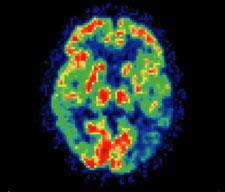 Alzheimer-brain-225