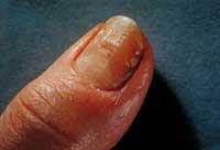 fingernail-infection-200