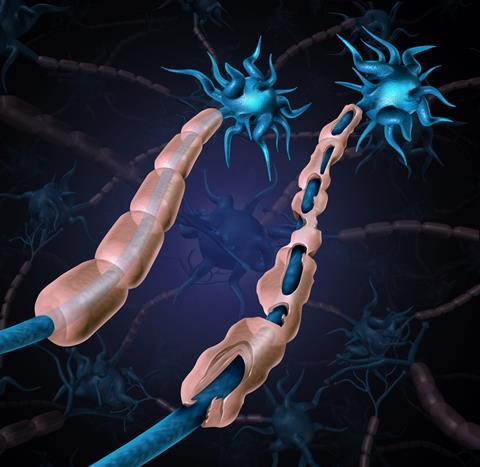 A healthy nerve with an intact myelin sheathe beside one affected by multiple sclerosis