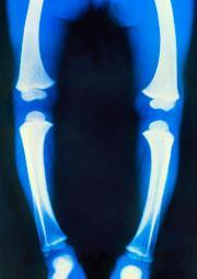 X-ray_of_the_legs_of_a_child_with_rickets-SPL_RIGHTS-MANAGED_180