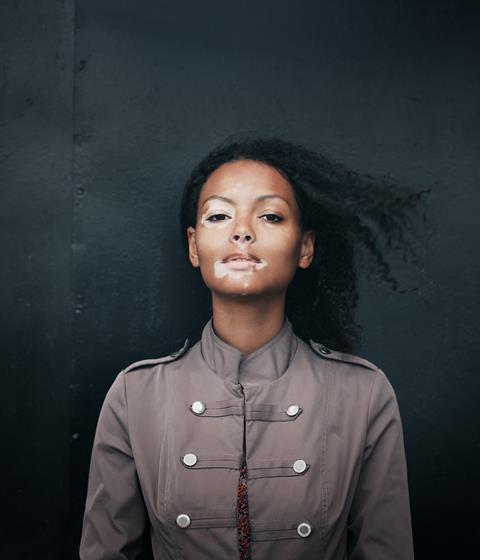 A model with facial vitiligo