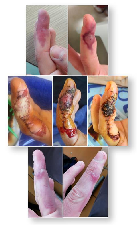 Dichloromethane injection injury – 7 images showing from 10 minutes through to 1 year after the accident