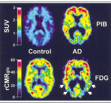Understanding Alzheimer's - PIB