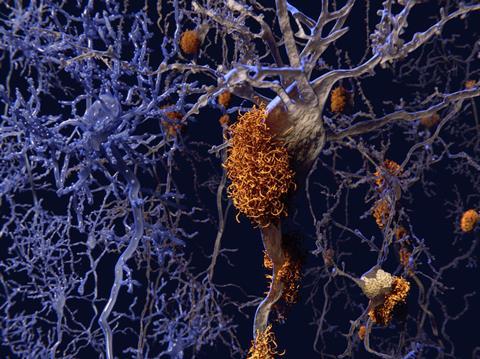 An image showing brain nerve cells affected by Alzheimer's