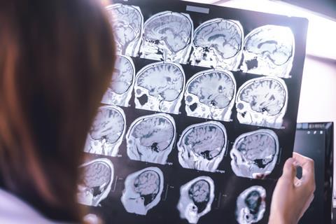 Frontal lobe atrophy on MRI film probably Frontotemporal Dementia.