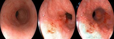 Examples of generated esophageal cancer images