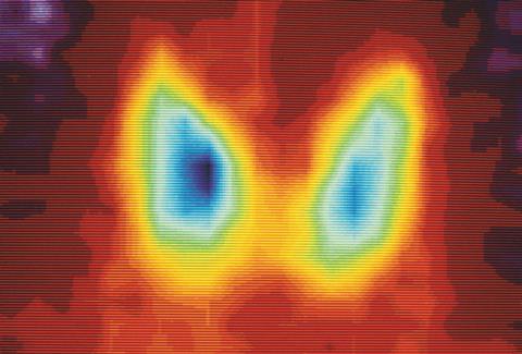 Coloured gamma scan of normal human thyroid gland using radioactive tracer Technetium-99m