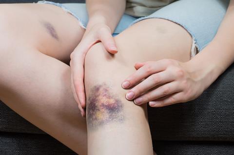 Colourful bruised knee