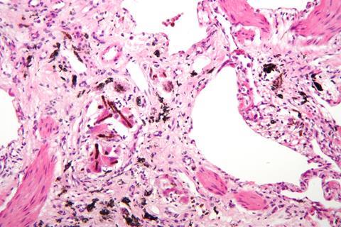 High magnification micrograph of asbestosis of the lung