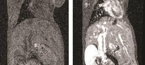 Before and after mn contrast agent