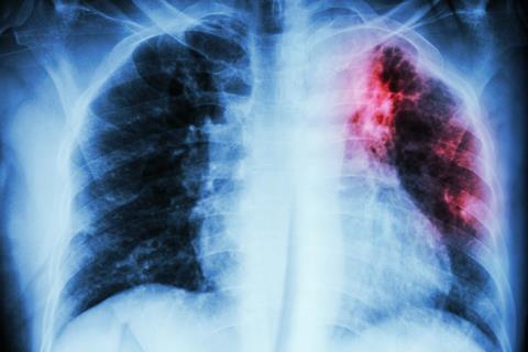 Pulmonary Tuberculosis chest X-ray