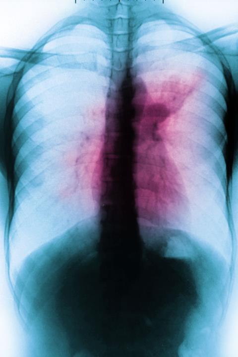 TB X-ray