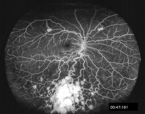 Fluorescein used to image retinal capillary hemangioma