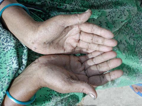 Hands showing signs of arsenic poisoning – arsenical keratosis 