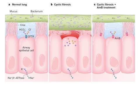 An image showing  amphotericin B tackles lung problems in cystic fibrosis