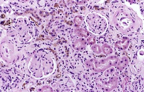 Hemosiderin deposits (brown stain) in a kidney