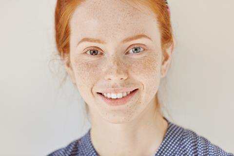 A redhead model with heterochromatic irises