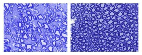 Images showing sciatic nerves isolated from untreated (left) Lama2-deficient mice shows evidence of demyelination, which is improved upon treatment (right)