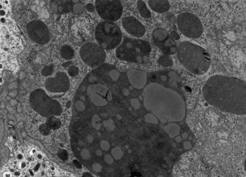 Electron microscope (TEM) micrograph showing many lysosomes (dark granules)