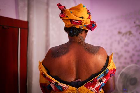 Woman's back affected by skin lightening products